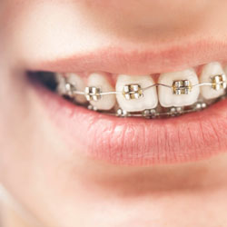 Close-up smile with braces